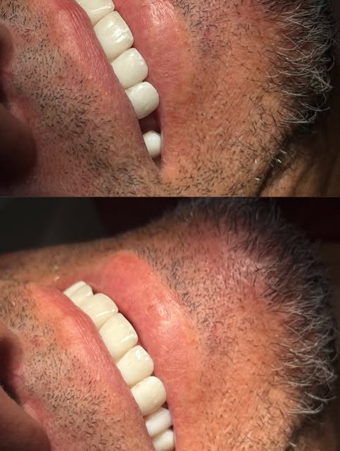 Detalhe de dentes com coroas antes e após o tratamento