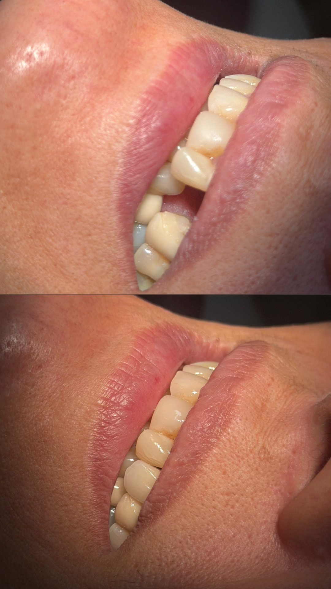 Detalhe dos dentes antes e após tratamento restaurador